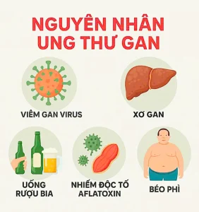 Nguyên nhân gây ung thư gan